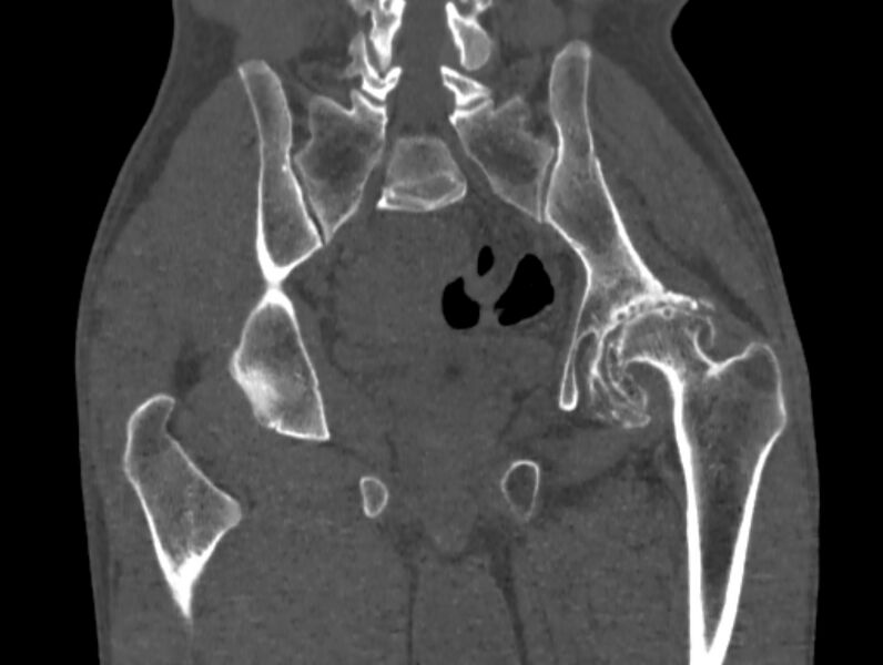 File:Avascular necrosis of the left hip (Radiopaedia 75068-86125 Coronal bone window 55).jpg