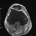 Avulsion fracture of the fibular head (Radiopaedia 74804-85808 Axial PD fat sat 12).jpg
