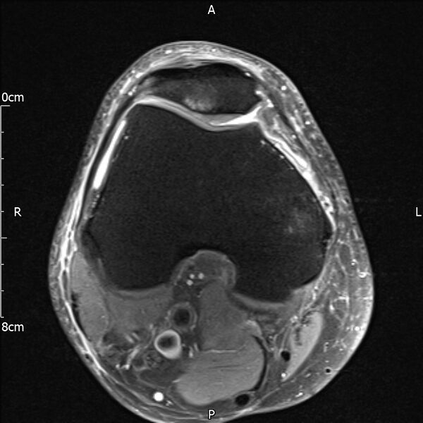 File:Avulsion fracture of the fibular head (Radiopaedia 74804-85808 Axial PD fat sat 12).jpg