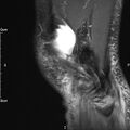Avulsion fracture of the fibular head (Radiopaedia 74804-85808 Sagittal PD fat sat 29).jpg