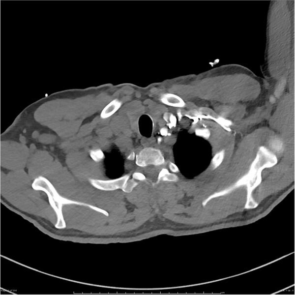File:Azygos venous system anatomy (CT pulmonary angiography) (Radiopaedia 25928-26077 Axial C+ CTPA 7).jpg