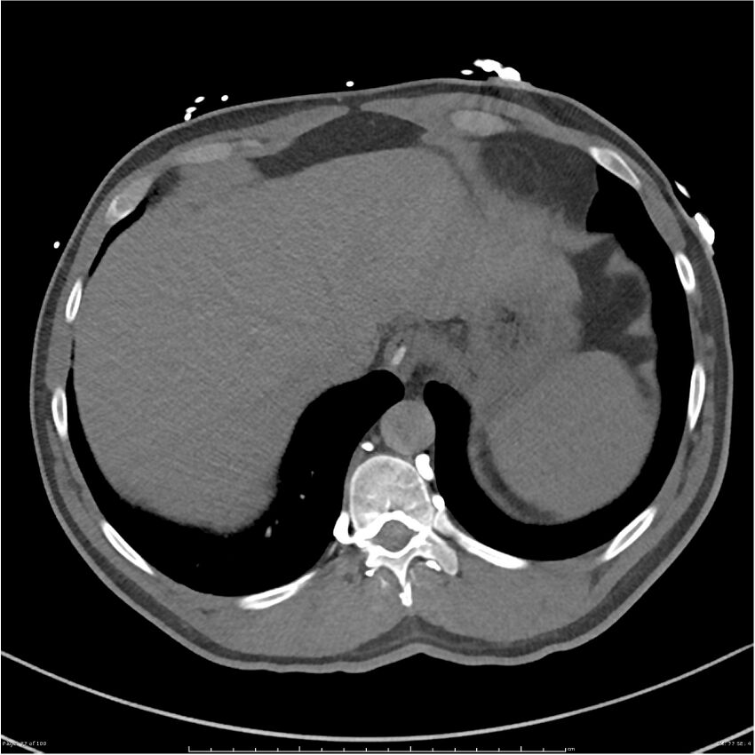 Azygos venous system anatomy (CT pulmonary angiography) (Radiopaedia 25928-26077 Axial C+ CTPA 77).jpg