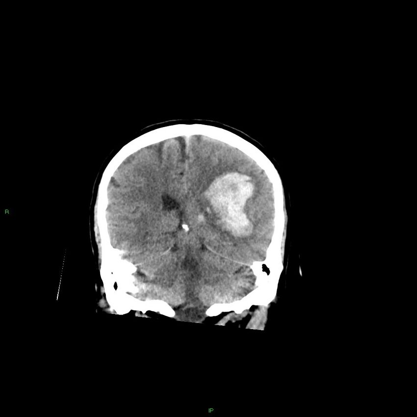 Basal ganglia hemorrhage (Radiopaedia 58349-65472 Coronal non-contrast 27).jpg