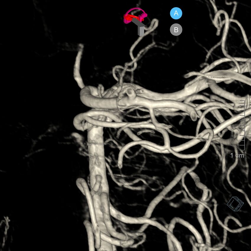 Basilar artery perforator aneurysm (Radiopaedia 82455-97734 3D view left VA 175).jpg