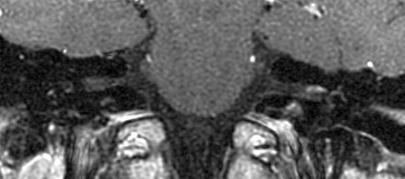 File:Bell palsy- intrameatal facial nerve enhancement (Radiopaedia 14242).jpg