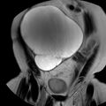 Benign seromucinous cystadenoma of the ovary (Radiopaedia 71065-81300 F 7).jpg