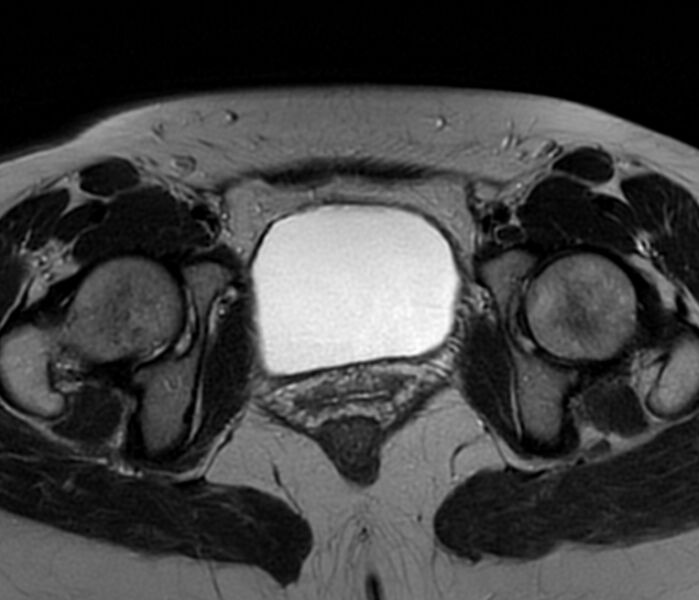 File:Bicornuate uterus (Radiopaedia 76407-88114 Axial T2 22).jpg