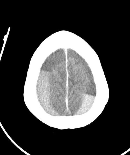 File:Bilateral acute on chronic subdural hematomas (Radiopaedia 78466-91146 Axial non-contrast 47).jpg