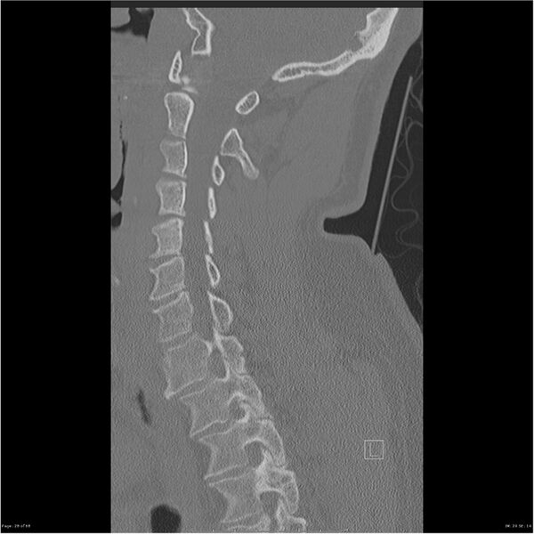 File:Bilateral cervical ribs (Radiopaedia 25868-26017 Sagittal bone window 28).jpg