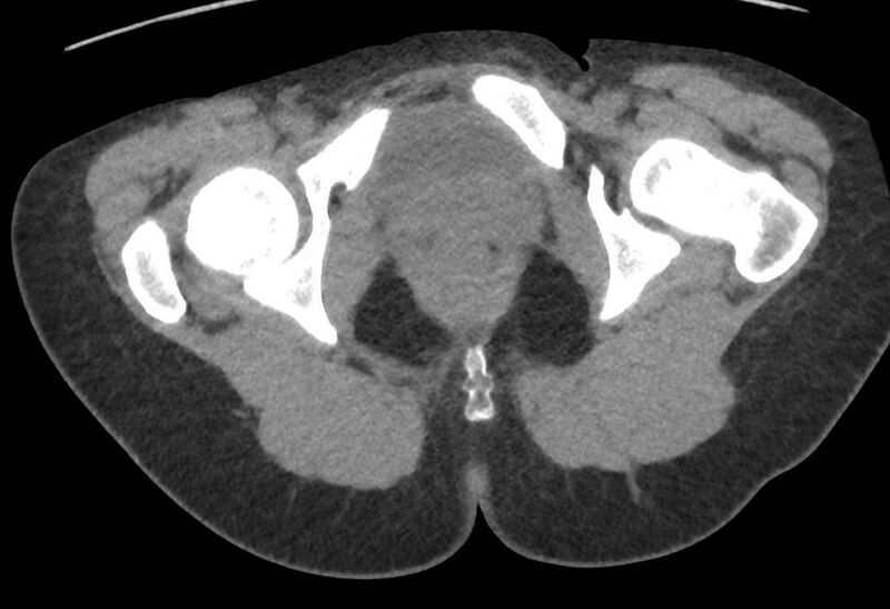 File:Bilateral mature cystic ovarian teratoma (Radiopaedia 88821-105592 Axial non-contrast 57).jpg