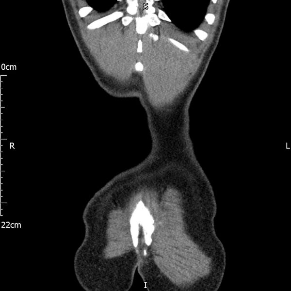 File:Bilateral medullary nephrocalcinosis with ureteric calculi (Radiopaedia 71269-81569 Coronal non-contrast 71).jpg