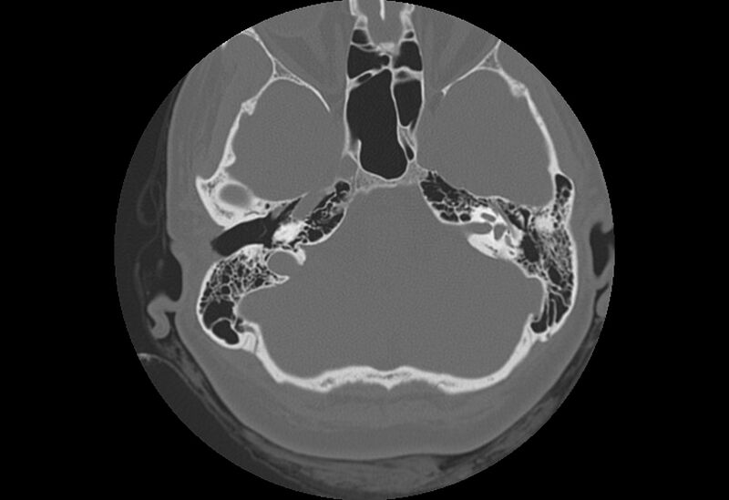File:Bilateral otospongiosis (Radiopaedia 35447-36940 Axial bone window 26).jpg