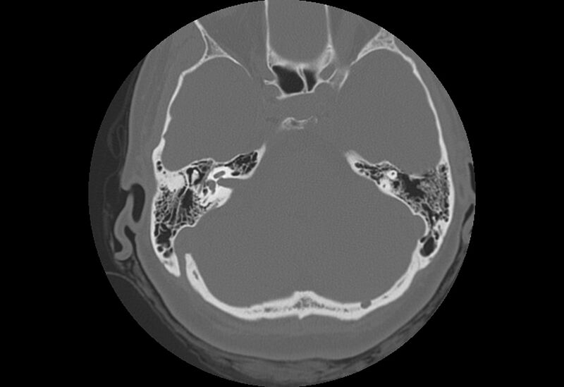 File:Bilateral otospongiosis (Radiopaedia 35447-36940 Axial bone window 35).jpg