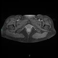 Bilateral ovarian fibroma (Radiopaedia 44568-48293 Axial T1 C+ fat sat 29).jpg