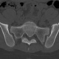 Bilateral pars defect (Radiopaedia 26691-26846 Axial bone window 85).jpg
