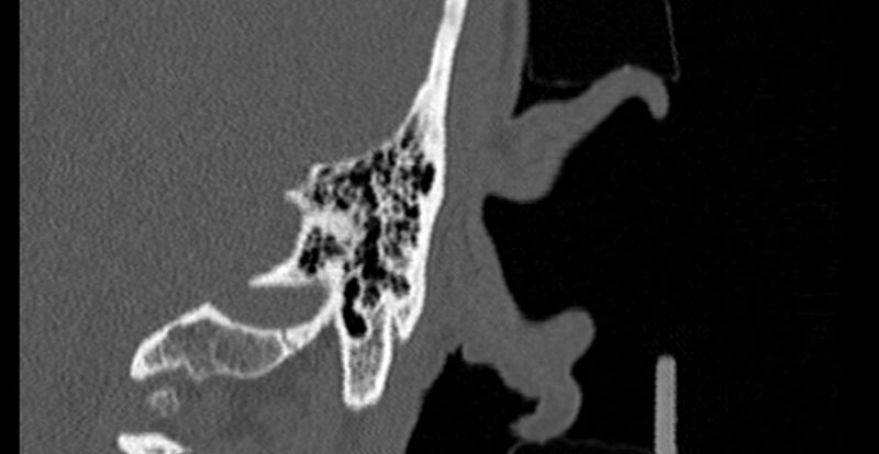 File:Bilateral temporal bone fractures (Radiopaedia 29482-29970 B 88).jpg