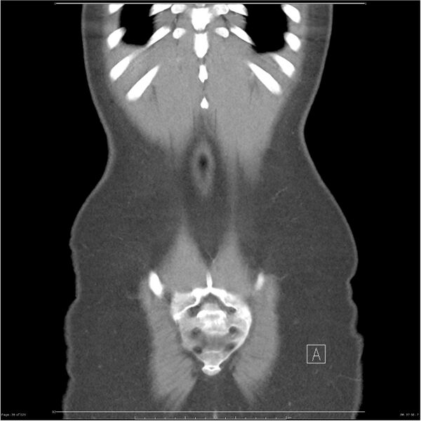 File:Bilateral ureteritis and cystitis (Radiopaedia 25340-25594 B 36).jpg