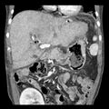 Biliary necrosis - liver transplant (Radiopaedia 21876-21846 C 18).jpg
