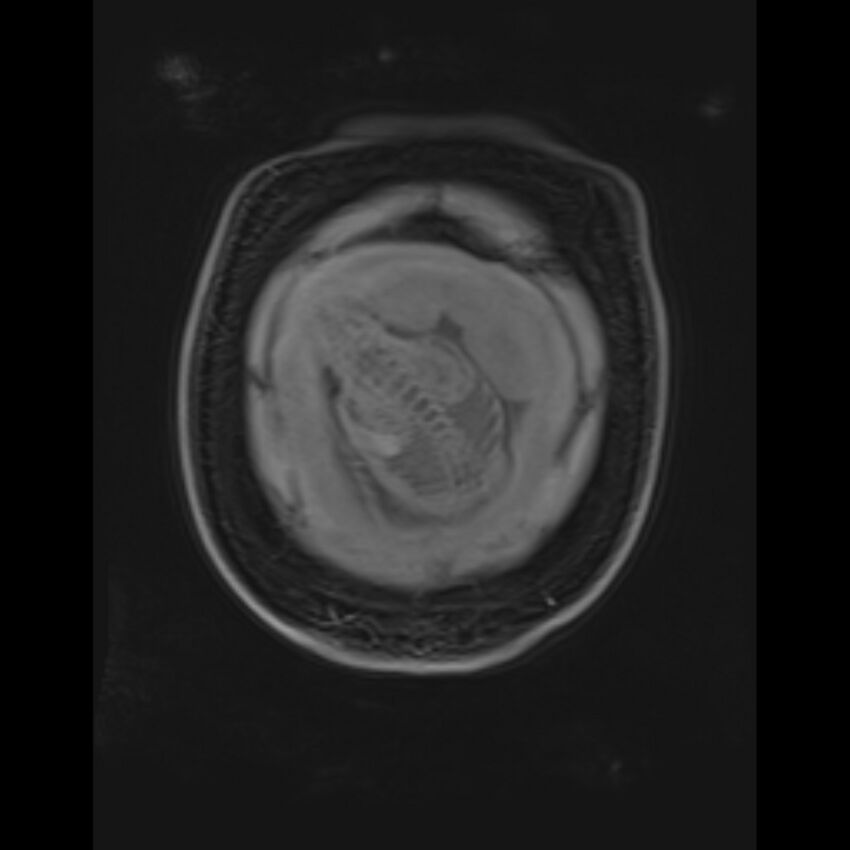 Bilobed placenta accreta (Radiopaedia 69648-79591 Coronal T1 vibe 21).jpg