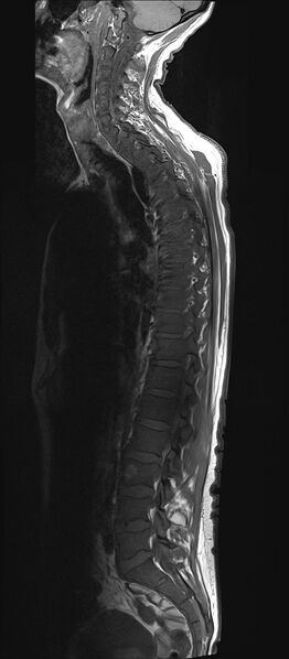 File:Bing-Neel syndrome (Radiopaedia 71453-81799 Sagittal T1 4).jpg