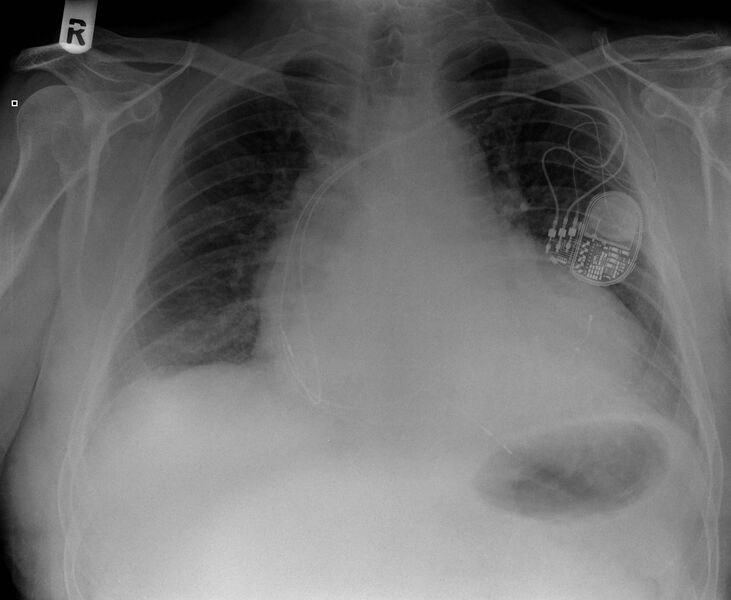 File:Biventricular cardiac pacemaker (Radiopaedia 13192).jpg