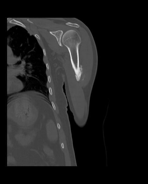 File:Bizarre parosteal osteochondromatous proliferation (Radiopaedia 84221-99501 Coronal bone window 12).jpg