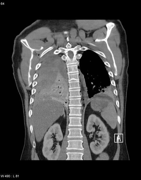 File:Boerhaave syndrome with tension pneumothorax (Radiopaedia 56794-63605 B 27).jpg