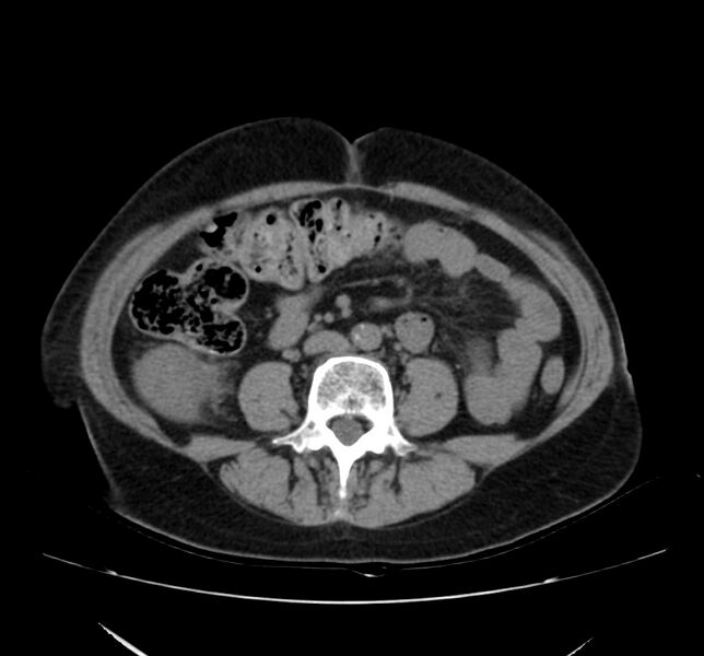 File:Bosniak renal cyst - type IV (Radiopaedia 22929-22953 Axial non-contrast 34).jpg