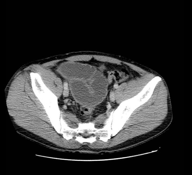 File:Bowel obstruction from colon carcinoma (Radiopaedia 22995-23028 A 71).jpg