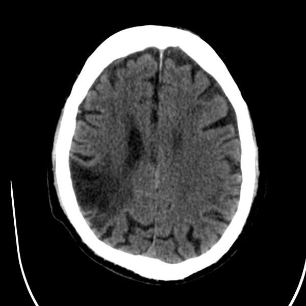 File:Brain Pantopaque remnants (Radiopaedia 78403-91048 Axial non-contrast 62).jpg