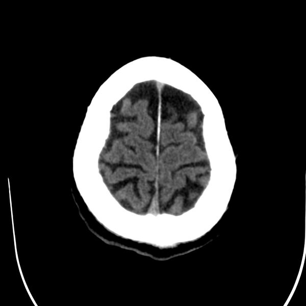 File:Brain Pantopaque remnants (Radiopaedia 78403-91048 Axial non-contrast 80).jpg