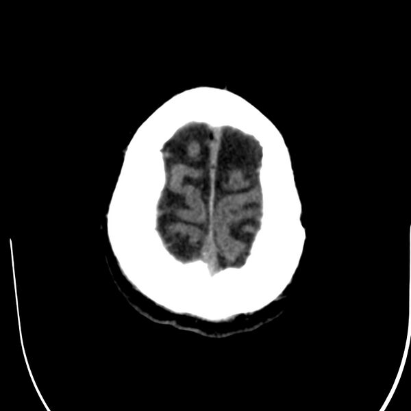 File:Brain Pantopaque remnants (Radiopaedia 78403-91048 Axial non-contrast 83).jpg