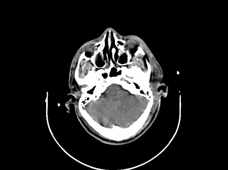 File:Brain injury by firearm projectile (Radiopaedia 82068-96087 B 63).jpg