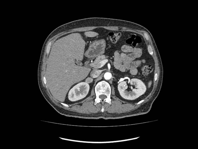 File:Brain metastases from renal cell carcinoma (Radiopaedia 42222-45328 A 53).jpg