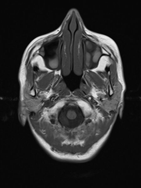 File:Brain metastasis as initial presentation of non-small cell lung cancer (Radiopaedia 65122-74126 Axial T1 3).jpg