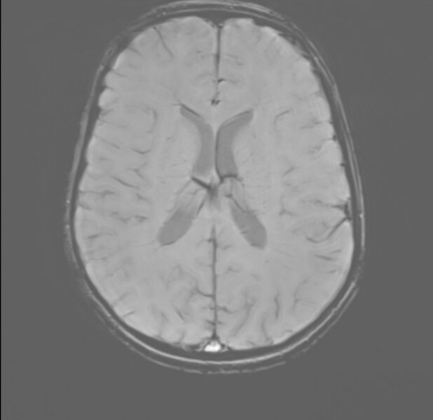 File:Brainstem glioma (Radiopaedia 70548-80674 Axial SWI 38).jpg