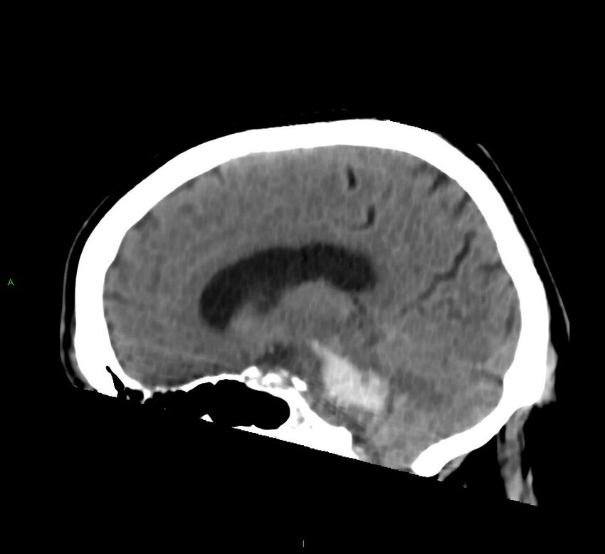 Brainstem hemorrhage (Radiopaedia 58794-66028 C 22).jpg