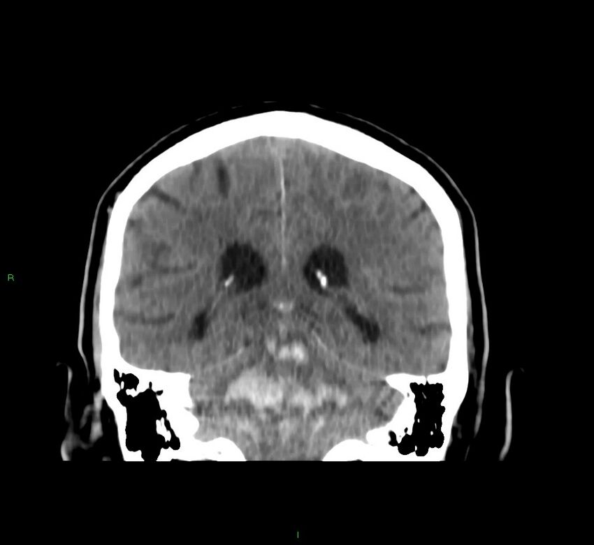Brainstem hemorrhage (Radiopaedia 58794-66028 Coronal non-contrast 26).jpg