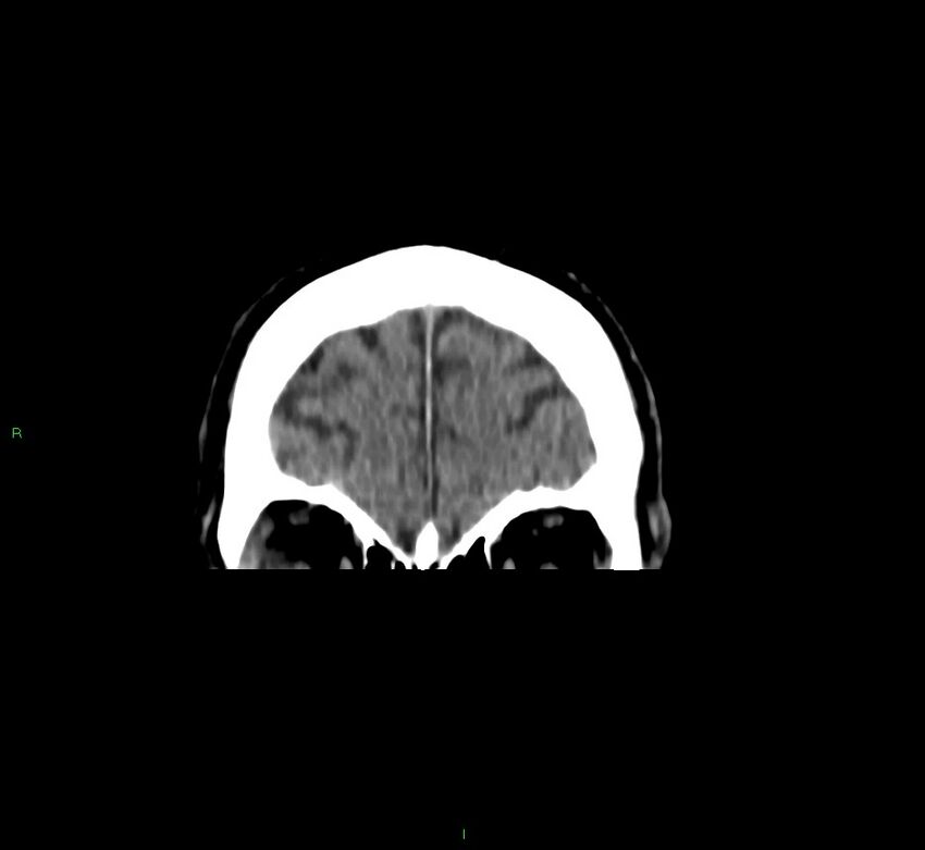 Brainstem hemorrhage (Radiopaedia 58794-66028 Coronal non-contrast 56).jpg