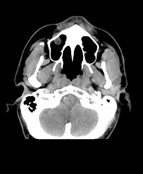 File:Branchial cleft cyst (Radiopaedia 31167-31875 Axial C+ delayed 6).jpg