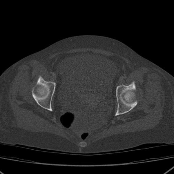 File:Breast cancer metastases - hepatic and skeletal (Radiopaedia 34201-35461 Axial bone window 100).jpg