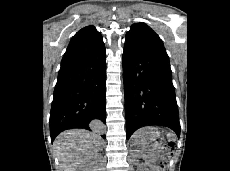 File:Bronchogenic cyst (Radiopaedia 80273-93615 D 85).jpg