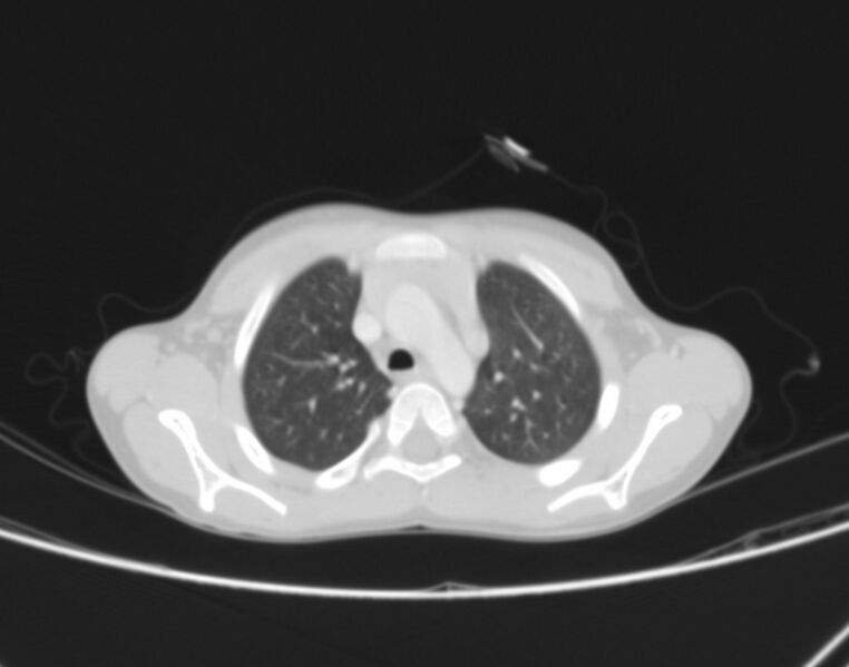 File:Bronchus suis (Radiopaedia 68131-77620 Axial lung window 10).jpg