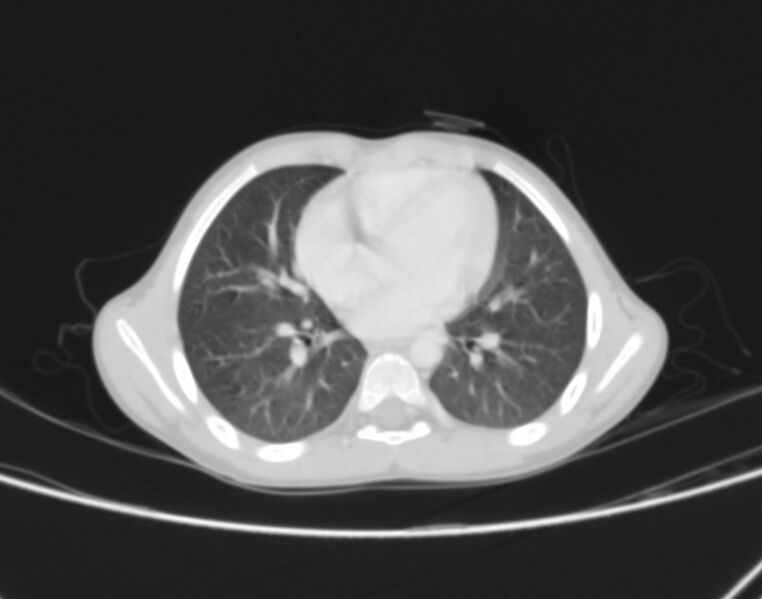 File:Bronchus suis (Radiopaedia 68131-77620 Axial lung window 54).jpg