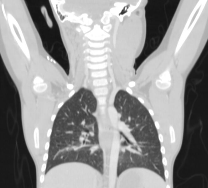 File:Bronchus suis (Radiopaedia 68131-77620 Coronal lung window 22).jpg