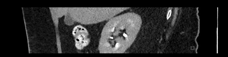 File:Buried bumper syndrome - gastrostomy tube (Radiopaedia 63843-72575 Sagittal Inject 94).jpg