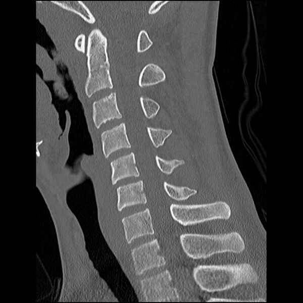 File:C5 facet fracture (Radiopaedia 58374-65499 Sagittal bone window 36).jpg