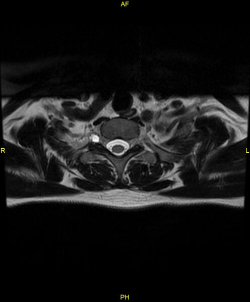 File:C5 nerve sheath tumor (Radiopaedia 85777-101596 Axial T2 83).jpg