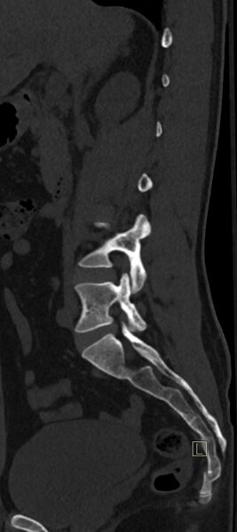 File:Calcaneal fractures with associated L2 burst fracture (Radiopaedia 71671-82493 Sagittal bone window 55).jpg