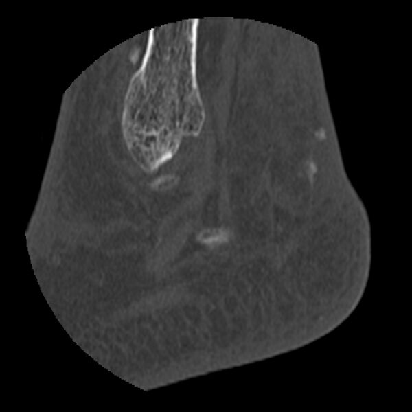 File:Calcaneal tuberosity avulsion fracture (Radiopaedia 22649-22668 D 3).jpg